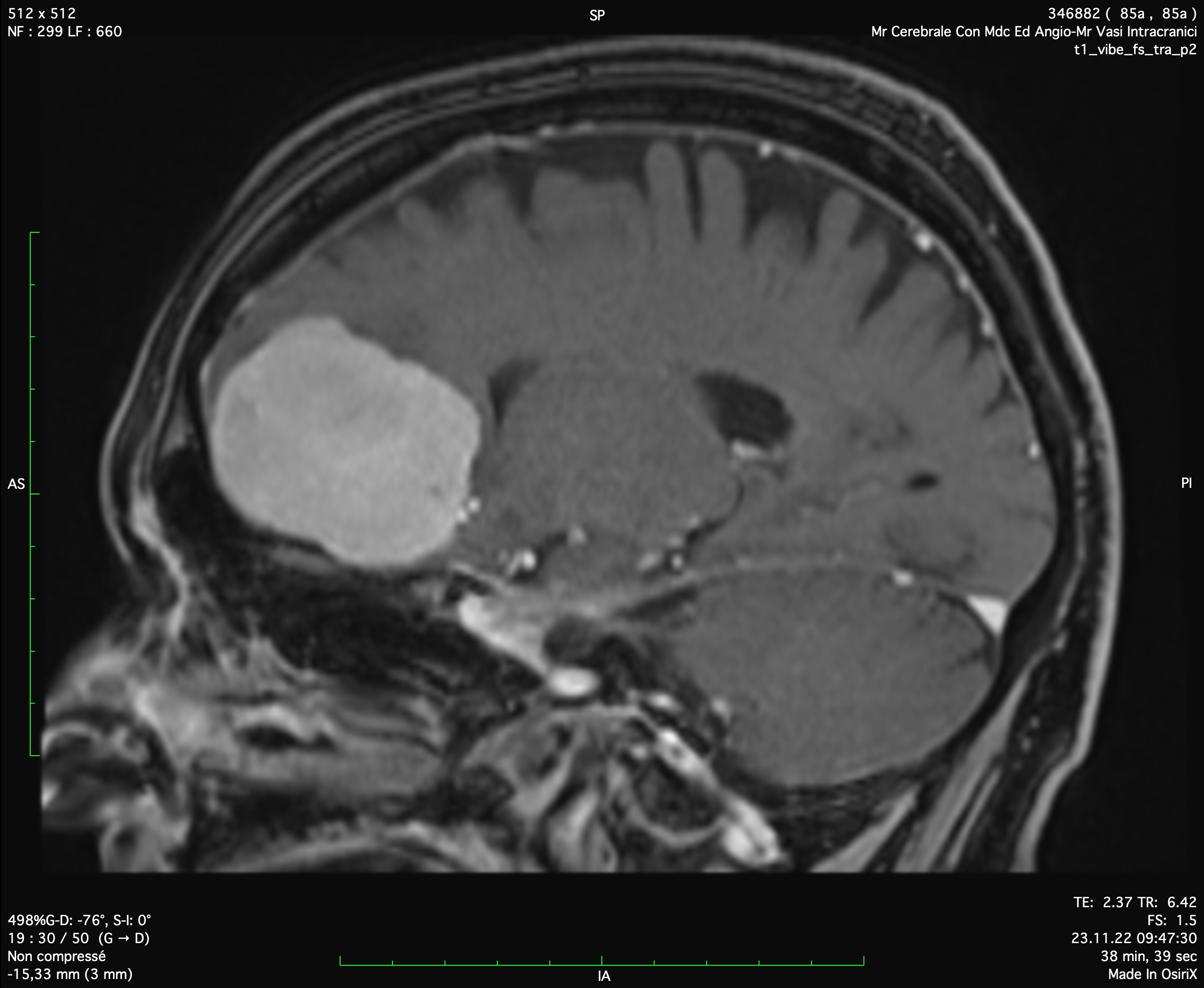 Cerebral Tumors Dr Thomas Robert